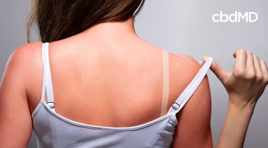 Does CBD Oil Help Sunburns? - cbdMD